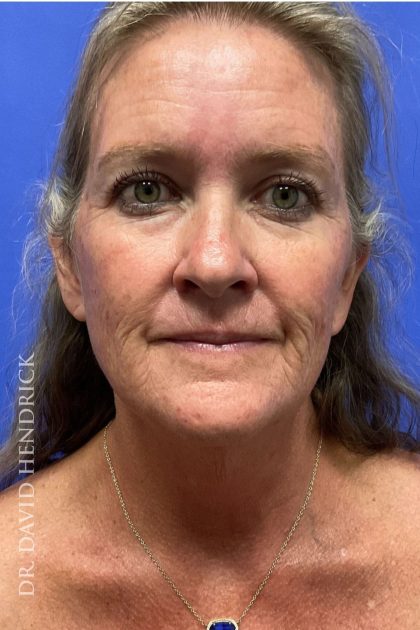 Brow Lift Before & After Patient #8421