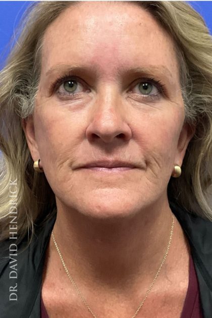 Brow Lift Before & After Patient #8421