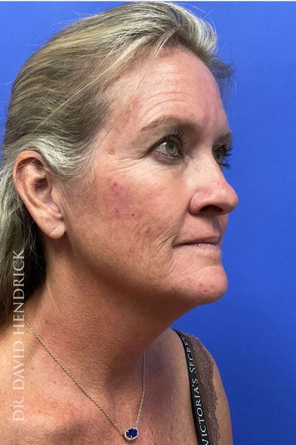 Brow Lift Before & After Patient #8421