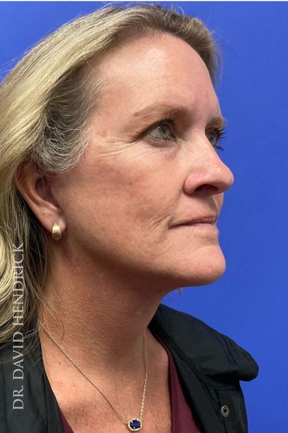 Brow Lift Before & After Patient #8421