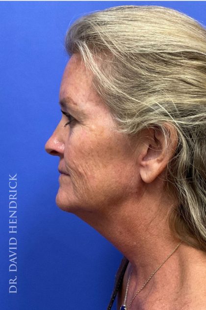 Brow Lift Before & After Patient #8421