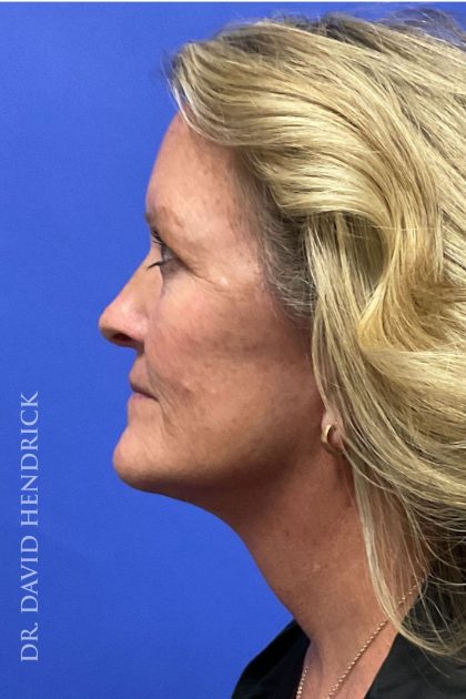 Brow Lift Before & After Patient #8421