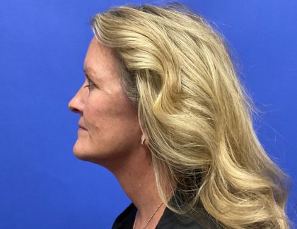 Facelift Before & After Patient #8421