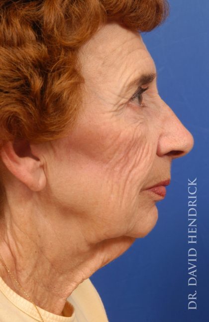 Facelift Before & After Patient #8884