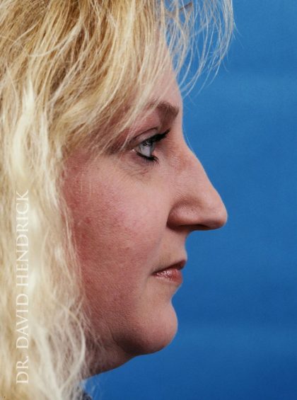Rhinoplasty Before & After Patient #8967