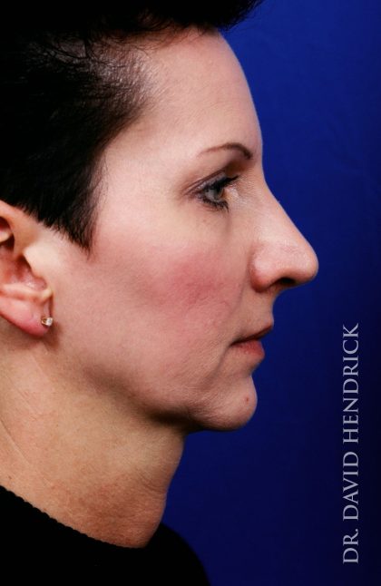 Face Implants Before & After Patient #8885