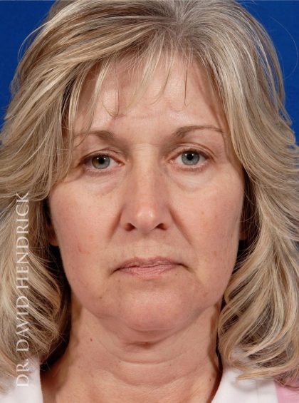 Deep Plane Facelift Before & After Patient #8974