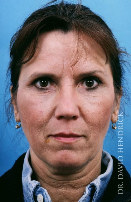 Facelift Before & After Patient #8895