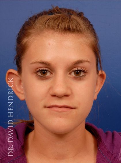 Otoplasty Before & After Patient #8988