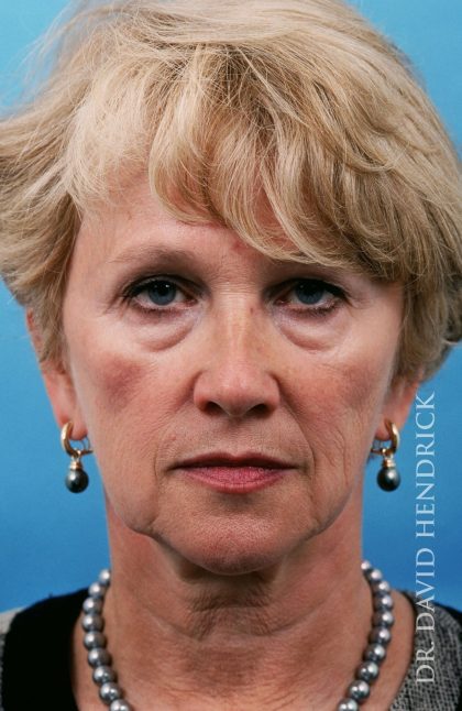 Facelift Before & After Patient #8903