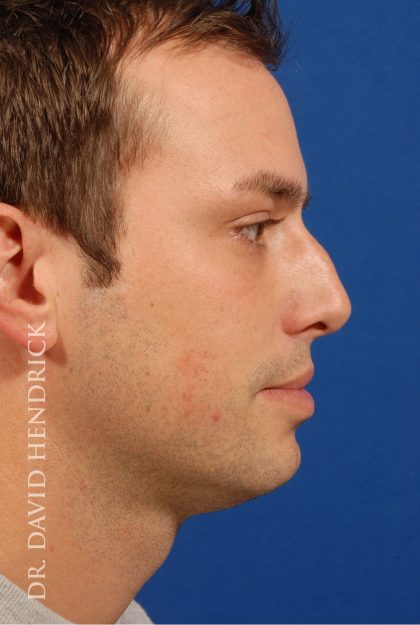 Rhinoplasty Before & After Patient #8995