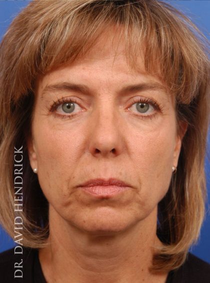 Deep Plane Facelift Before & After Patient #9002