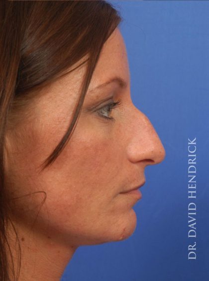 Rhinoplasty Before & After Patient #8931