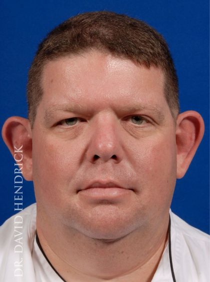 Otoplasty Before & After Patient #9007