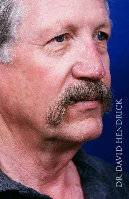 Neck Lift Before & After Patient #9014