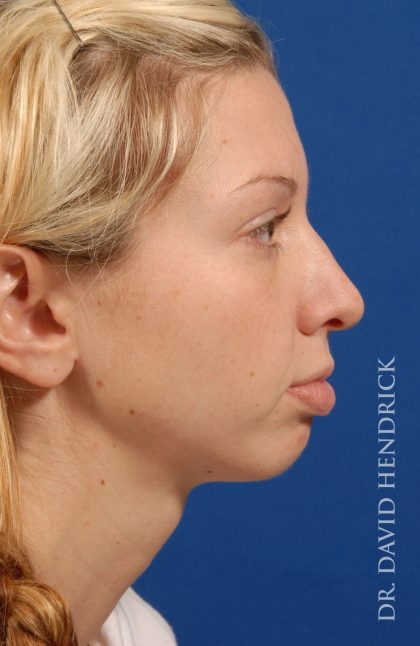 Face Implants Before & After Patient #8912