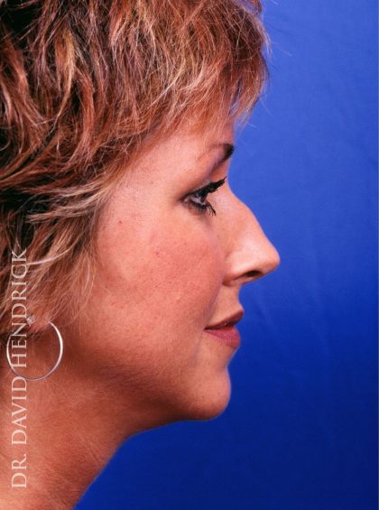 Rhinoplasty Before & After Patient #9019