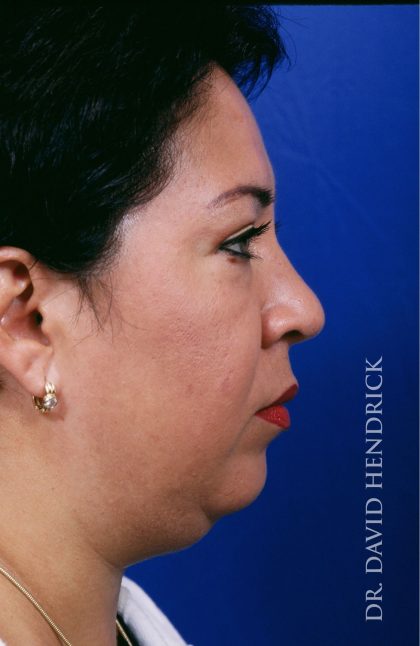 Face Implants Before & After Patient #8913