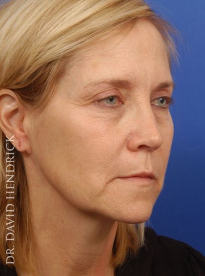Deep Plane Facelift Before & After Patient #9026