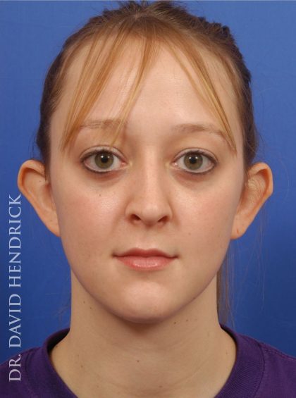 Otoplasty Before & After Patient #9031
