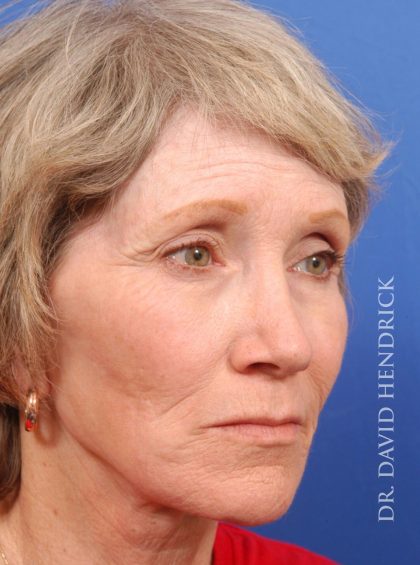 Face Implants Before & After Patient #8920