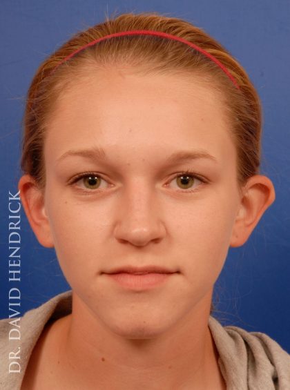 Otoplasty Before & After Patient #9038