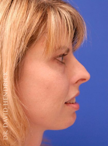 Rhinoplasty Before & After Patient #9045