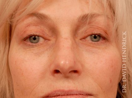 Deep Plane Facelift Before & After Patient #8936