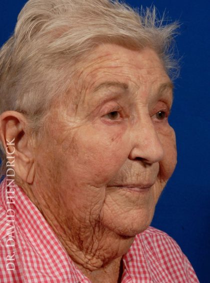 Neck Lift Before & After Patient #9052