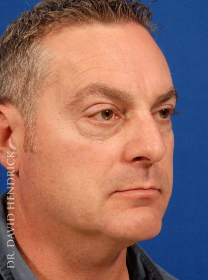 Face Implants Before & After Patient #8850