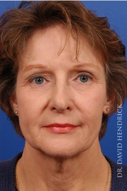 Facelift Before & After Patient #8847