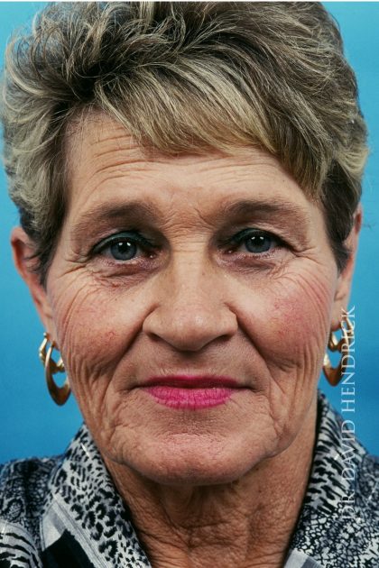 Facelift Before & After Patient #8840