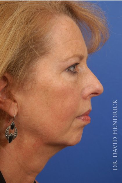 Face Implants Before & After Patient #8829