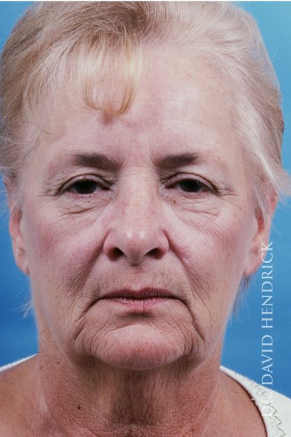 Facelift Before & After Patient #8819