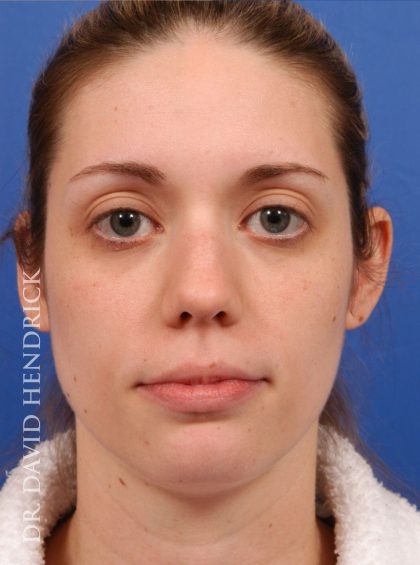 Face Implants Before & After Patient #8875