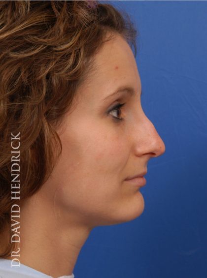 Rhinoplasty Before & After Patient #8941