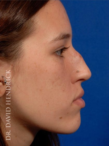 Rhinoplasty Before & After Patient #8948
