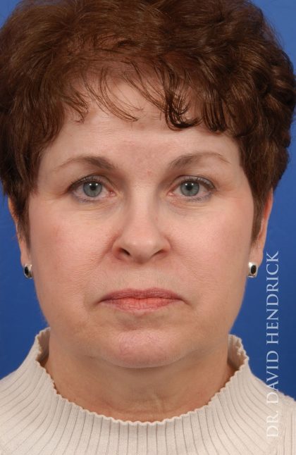 Facelift Before & After Patient #8857