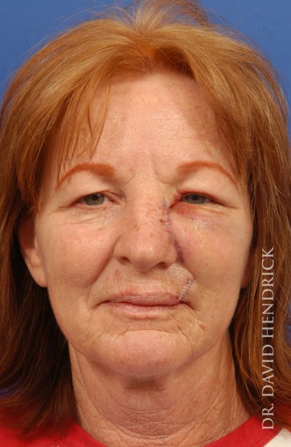 Facelift Before & After Patient #8859