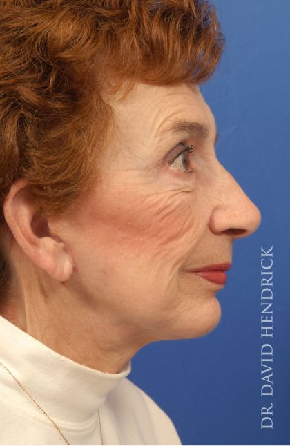 Facelift Before & After Patient #8884