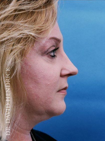 Rhinoplasty Before & After Patient #8967