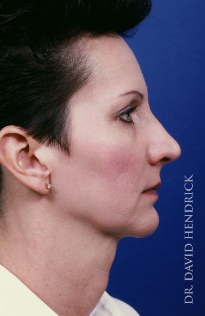 Face Implants Before & After Patient #8885