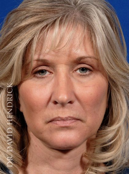 Deep Plane Facelift Before & After Patient #8974