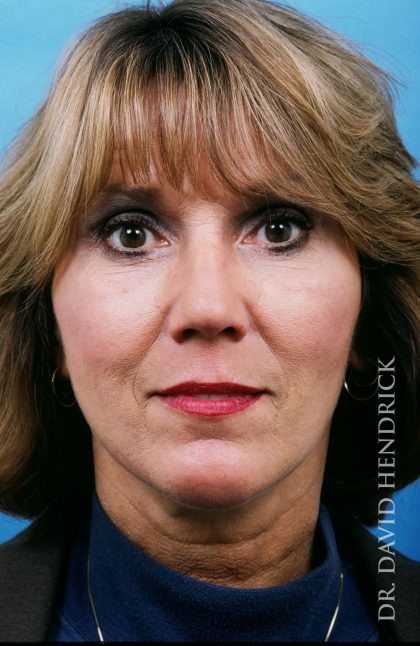 Facelift Before & After Patient #8895