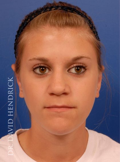 Otoplasty Before & After Patient #8988