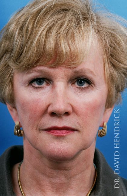 Facelift Before & After Patient #8903