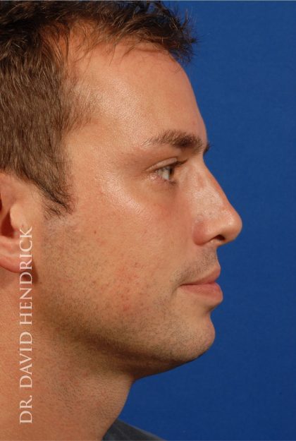Rhinoplasty Before & After Patient #8995