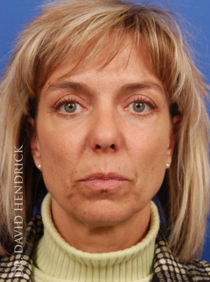 Deep Plane Facelift Before & After Patient #9002