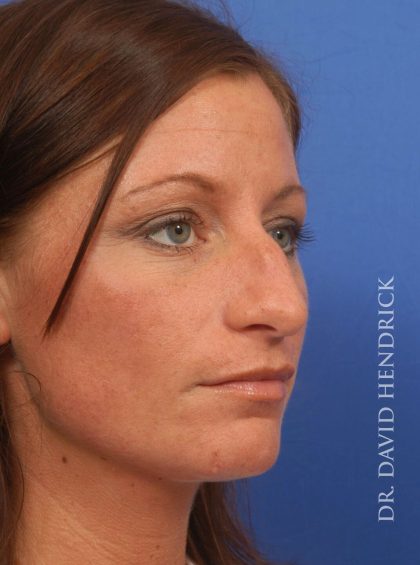 Rhinoplasty Before & After Patient #8931