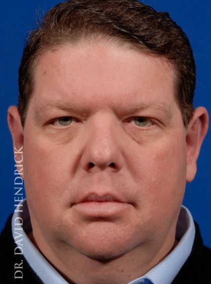 Otoplasty Before & After Patient #9007